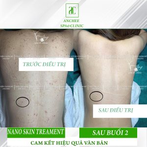 Spa Trị Mụn Lưng Uy Tín TPHCM