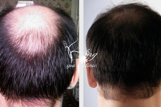 Góc thắc mắc: Hói đầu có chữa được không? [Bác sĩ giải đáp]