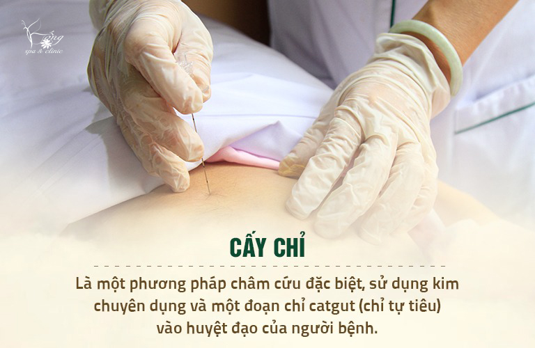 Cấy chỉ giảm béo - Phương pháp làm đẹp hiệu quả tối ưu nhất hiện nay