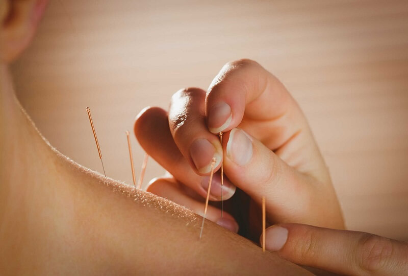 Cấy chỉ giảm béo - Phương pháp làm đẹp hiệu quả tối ưu nhất hiện nay
