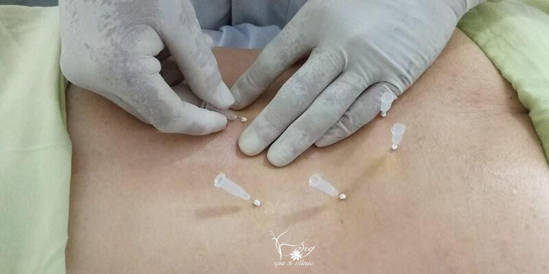 Cấy chỉ giảm béo - Phương pháp làm đẹp hiệu quả tối ưu nhất hiện nay