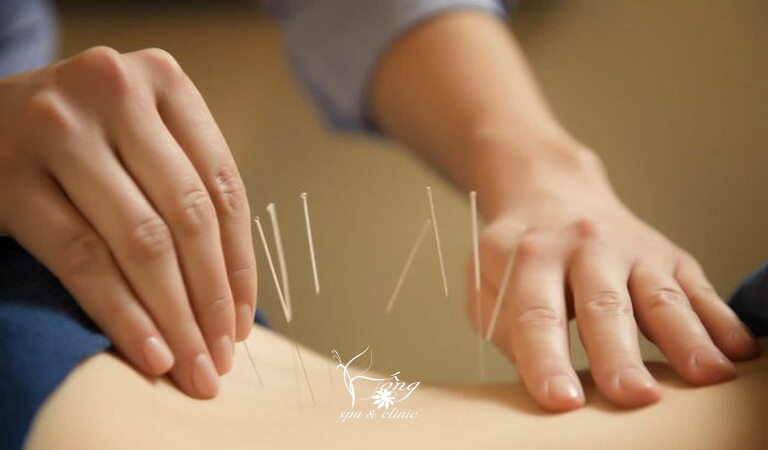 Cấy chỉ giảm béo - Phương pháp làm đẹp hiệu quả tối ưu nhất hiện nay
