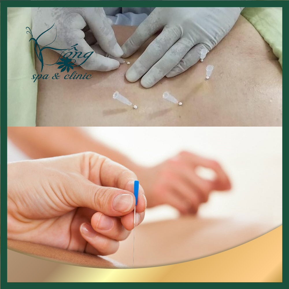 Cấy chỉ giảm béo - Phương pháp làm đẹp hiệu quả tối ưu nhất hiện nay