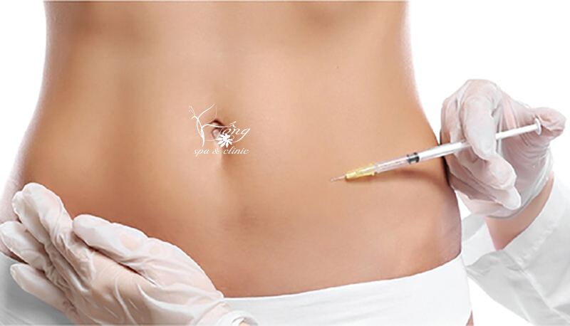 Cấy tinh chất giảm béo là gì? Có tốt không? Quy trình 5 bước hiệu quả