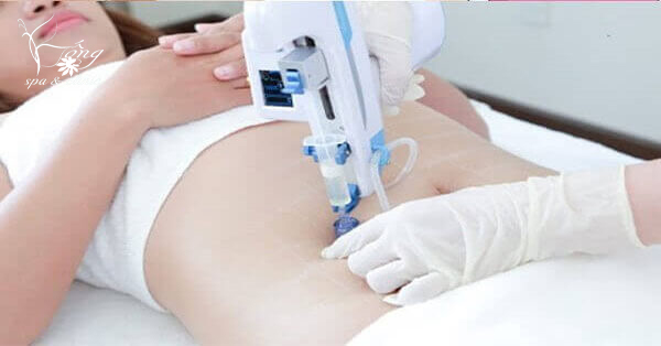 Cấy tinh chất giảm béo là gì? Có tốt không? Quy trình 5 bước hiệu quả