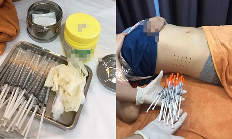 Cấy tinh chất giảm béo là gì? Có tốt không? Quy trình 5 bước hiệu quả