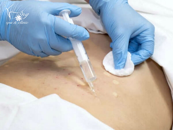 Cấy tinh chất giảm béo là gì? Có tốt không? Quy trình 5 bước hiệu quả