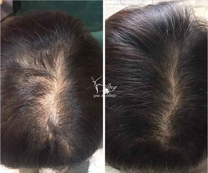 Hói đỉnh đầu nữ: Nguyên nhân, dấu hiệu & Cách điều trị hiệu quả