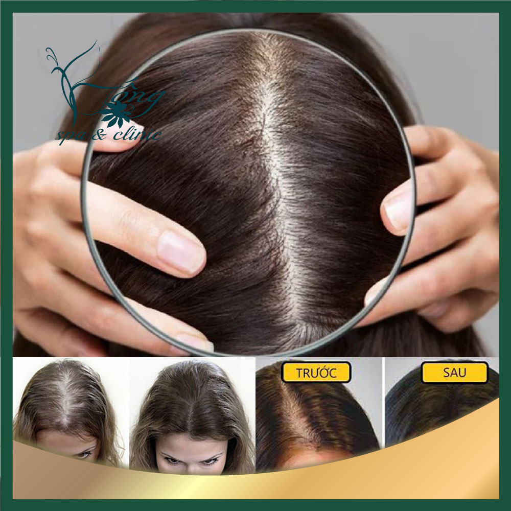 Hói đỉnh đầu nữ: Nguyên nhân, dấu hiệu & Cách điều trị hiệu quả