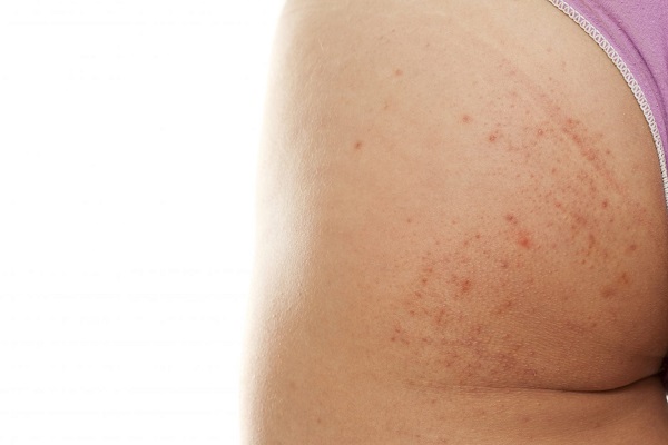 Phương pháp peel da mông có hiệu quả không? Quy trình & Bảng giá 2023