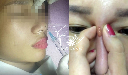 Tác Hại Của Tiêm Botox Gọn Hàm Gây Ra? Lưu Ý Khi Tiêm