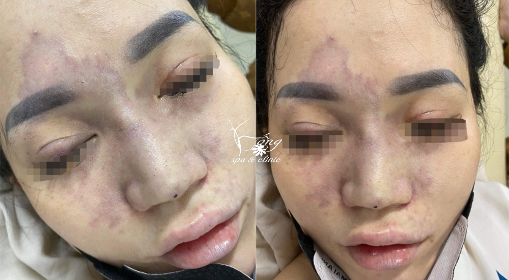 Tác Hại Của Tiêm Botox Gọn Hàm Gây Ra? Lưu Ý Khi Tiêm