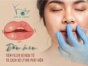Dấu hiệu tiêm Filler bị hoại tử