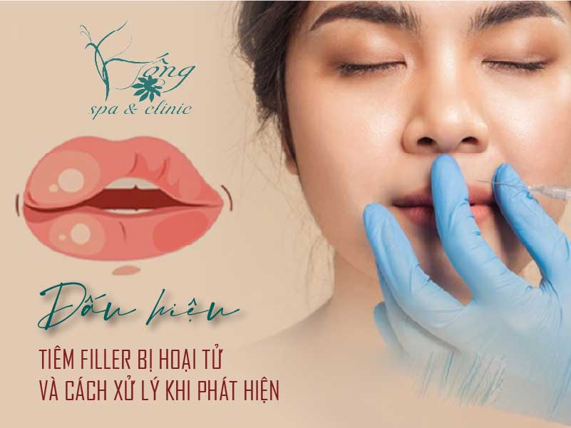 Dấu hiệu tiêm Filler bị hoại tử