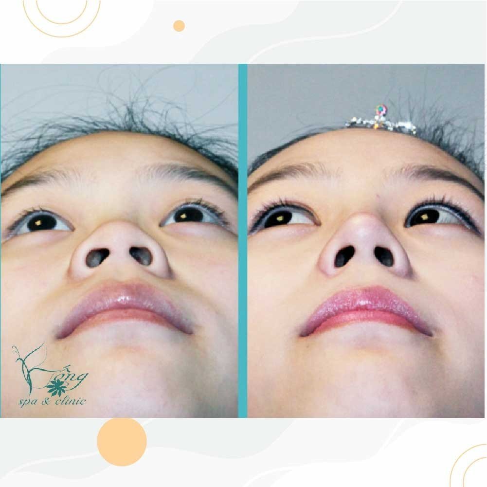 Nâng Mũi Chỉ Collagen Là Gì? Quy Trình - Giữ Bao Lâu