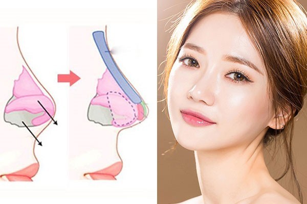 Nâng Mũi Chỉ Collagen Là Gì? Quy Trình - Giữ Bao Lâu