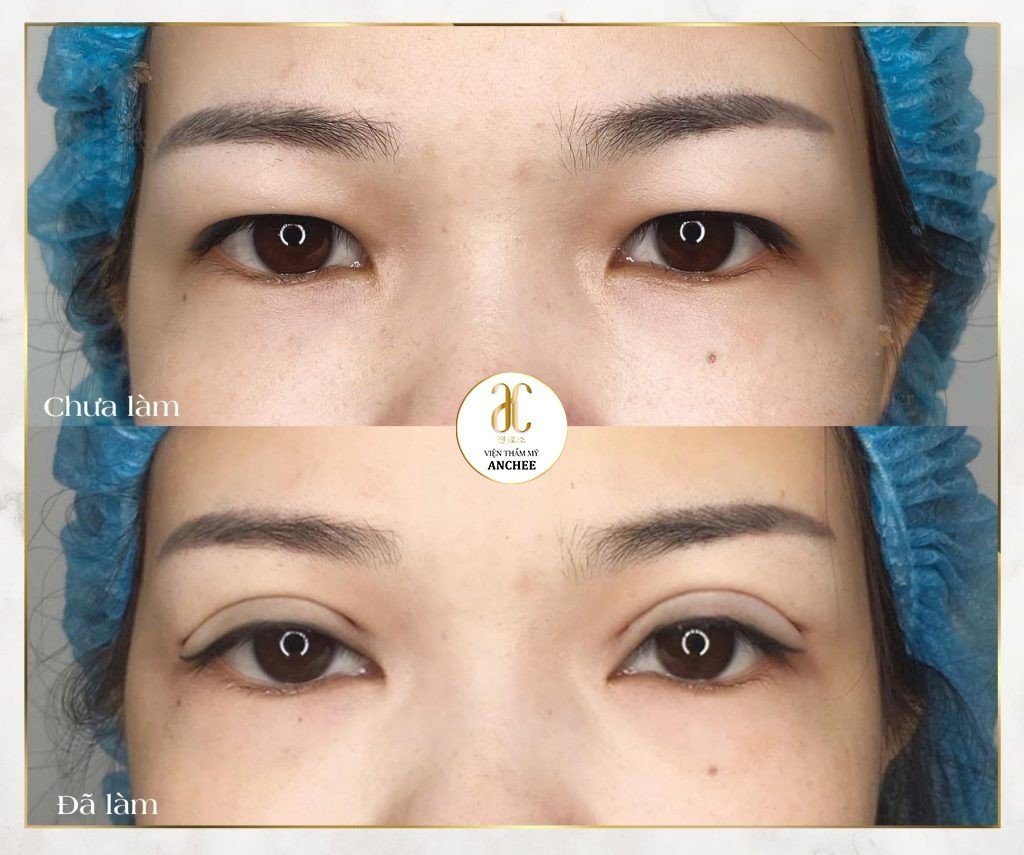 Nhấn Mí Được Bao Lâu? Yếu Tố Ảnh Hưởng & Cách Chăm Sóc