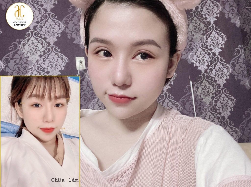 Nhấn Mí Được Bao Lâu? Yếu Tố Ảnh Hưởng & Cách Chăm Sóc