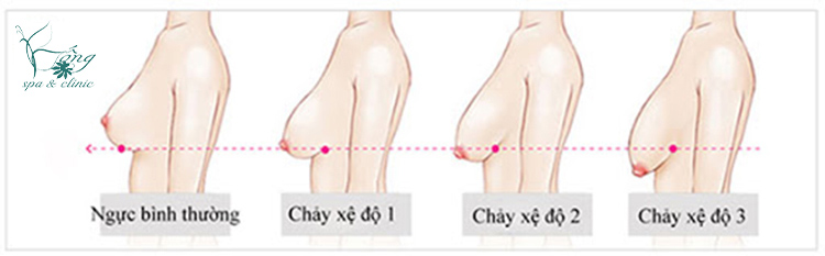 Dú Xệ (Ngực Xệ): 6 Nguyên Nhân & 7+ Cách Khắc Phục Hiệu Quả
