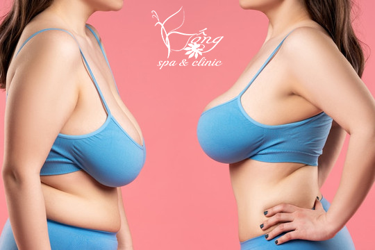 Dú Xệ (Ngực Xệ): 6 Nguyên Nhân & 7+ Cách Khắc Phục Hiệu Quả