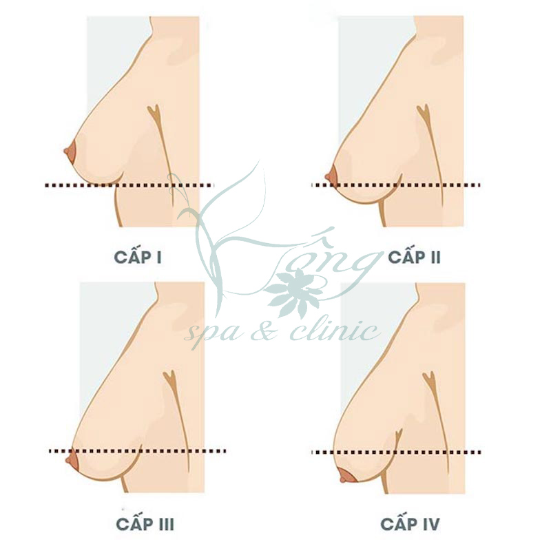 Dú Xệ (Ngực Xệ): 6 Nguyên Nhân & 7+ Cách Khắc Phục Hiệu Quả
