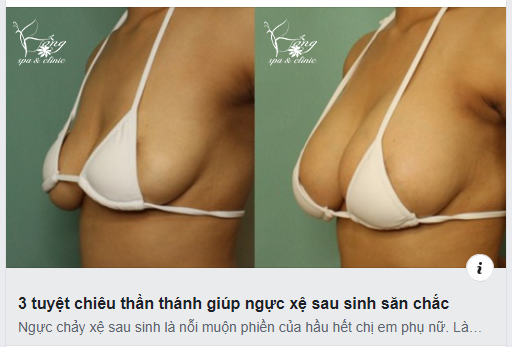 Dú Xệ (Ngực Xệ): 6 Nguyên Nhân & 7+ Cách Khắc Phục Hiệu Quả