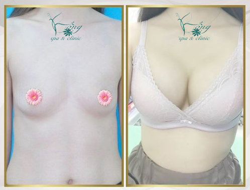 Dú Xệ (Ngực Xệ): 6 Nguyên Nhân & 7+ Cách Khắc Phục Hiệu Quả