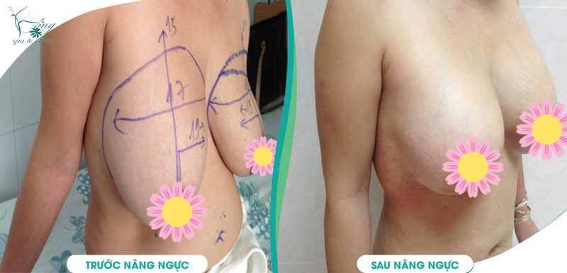 Dú Xệ (Ngực Xệ): 6 Nguyên Nhân & 7+ Cách Khắc Phục Hiệu Quả