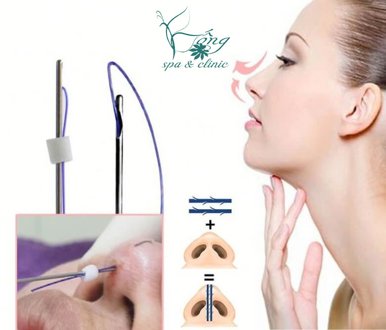 Nâng Mũi Bằng Chỉ Giá Bao Nhiêu Tiền? Bảng Giá Mới Nhất 2023