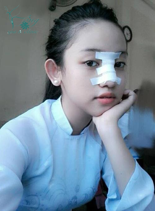 Nâng Mũi Có Đau Không? 3 Phương Pháp Nâng Mũi Không Đau?