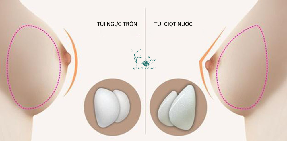 Đặt Túi Ngực - Lợi Ích, Quy Trình Và Địa Chỉ Đặt Túi Ngực