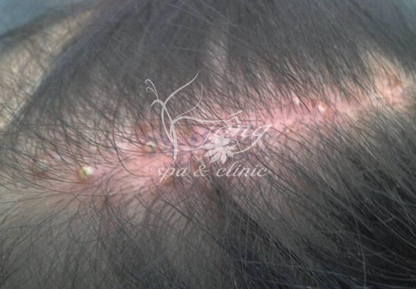 Nổi Mụn Trên Đầu: 4 Nguyên Nhân, 6 Dấu Hiệu & Cách Điều Trị