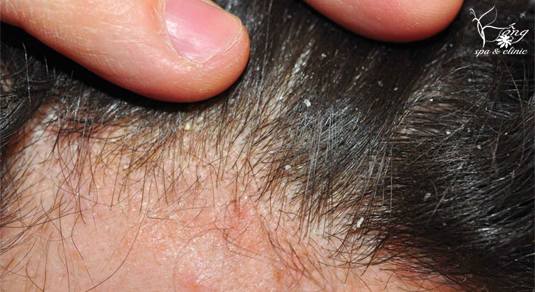 Nổi Mụn Trên Đầu: 4 Nguyên Nhân, 6 Dấu Hiệu & Cách Điều Trị