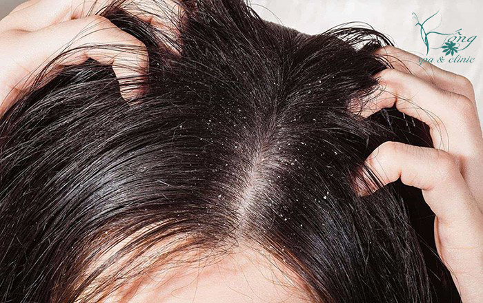 Nổi Mụn Trên Đầu: 4 Nguyên Nhân, 6 Dấu Hiệu & Cách Điều Trị