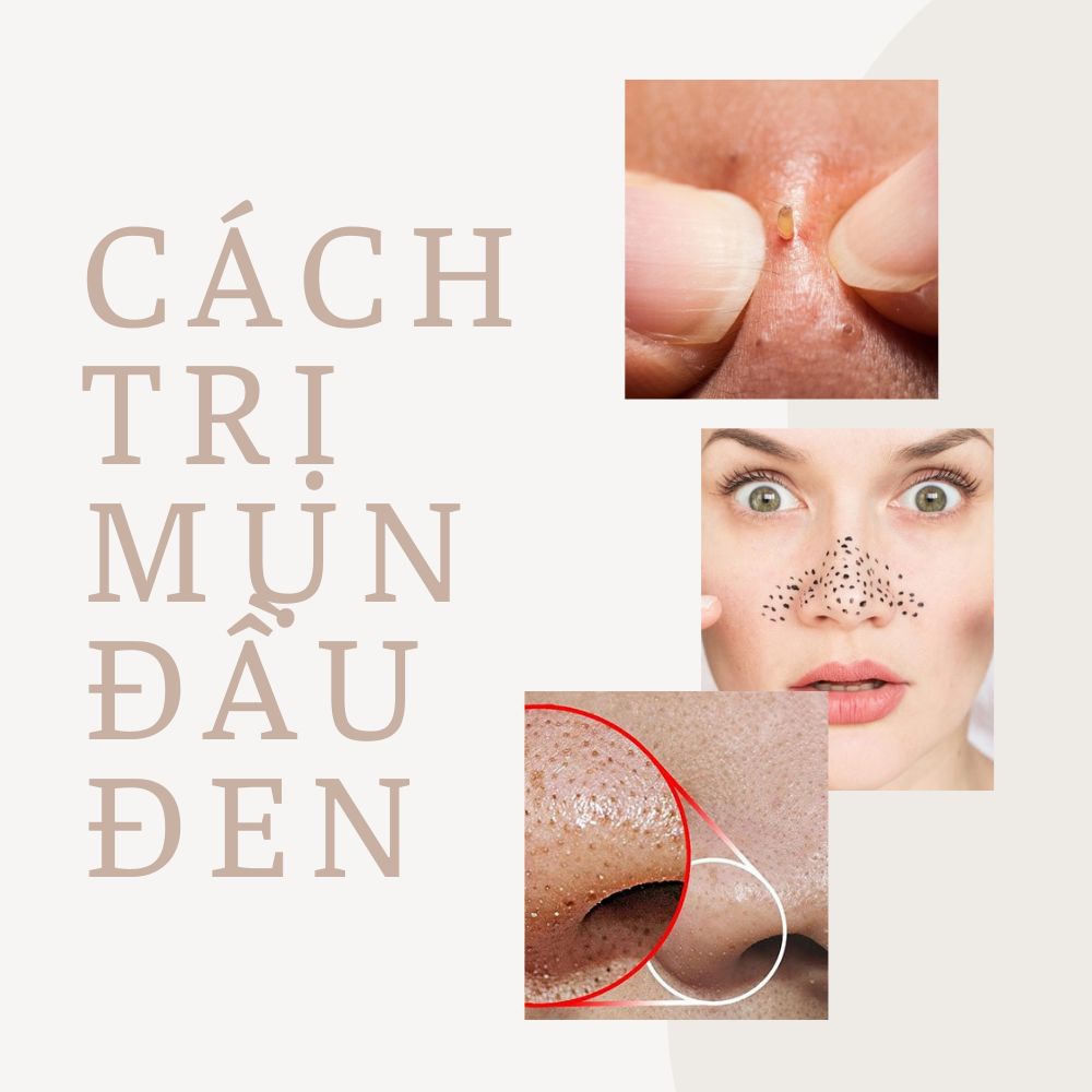 Thử Ngay 10+ Cách Trị Mụn Đầu Đen Ở Mũi Tại Nhà Hiệu Quả