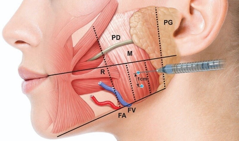 Botox Masseter - Bống Spa